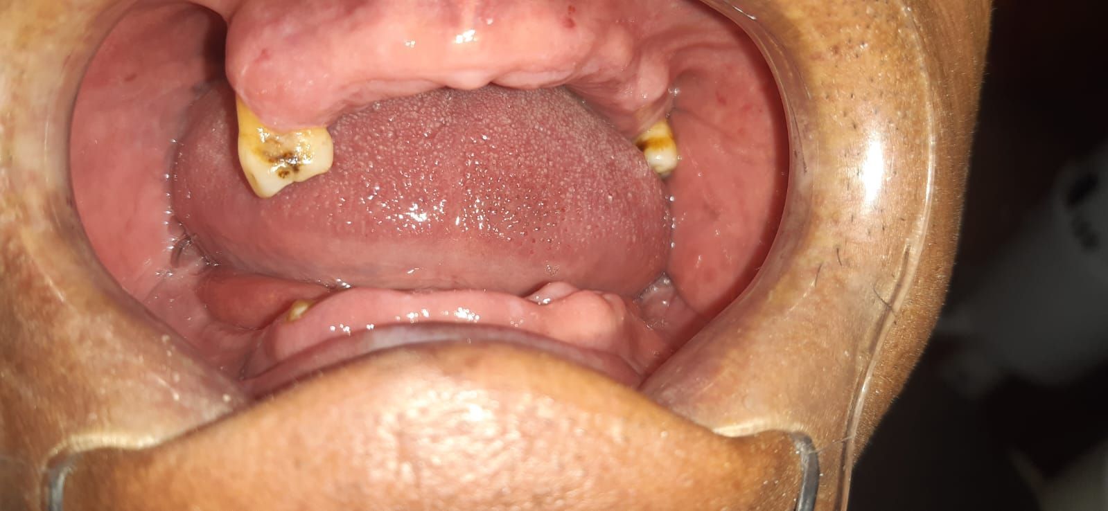 Boca abierta con dientes faltantes. Lengua visible. Encías enrojecidas. Quedan dos dientes amarillentos.