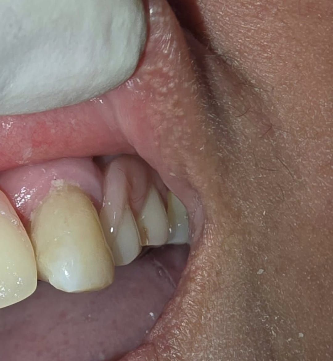 Primer plano de la boca de una persona, mostrando dientes y encías, con un objeto blanco cerca de los labios.