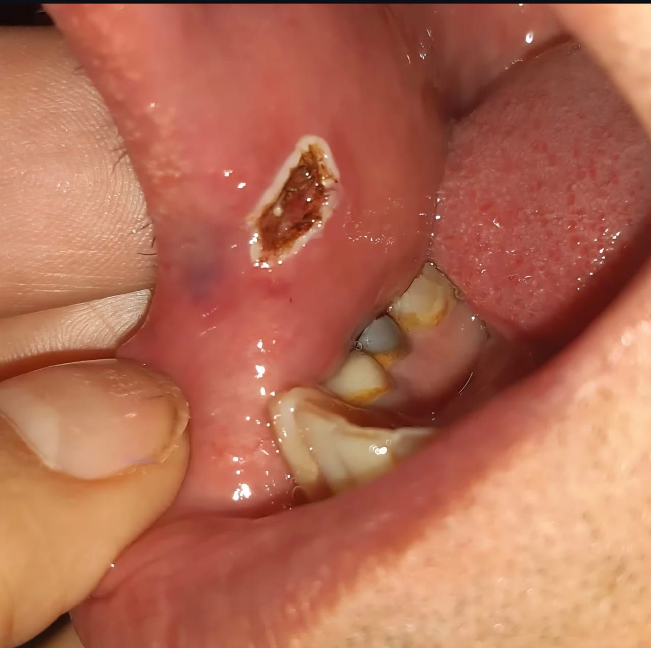 Interior de la boca que muestra una úlcera bucal en la mejilla interna, abierta con un dedo.