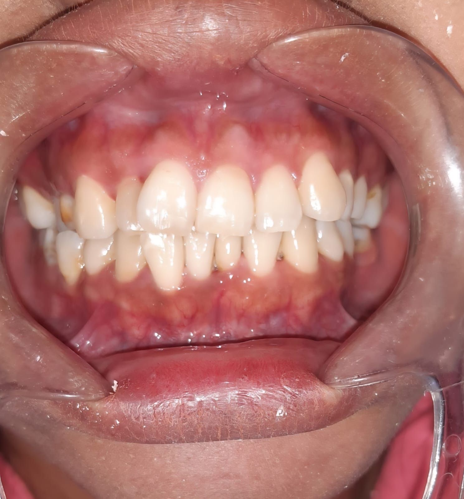 Boca abierta con los dientes expuestos, mantenidos abiertos por un retractor dental.