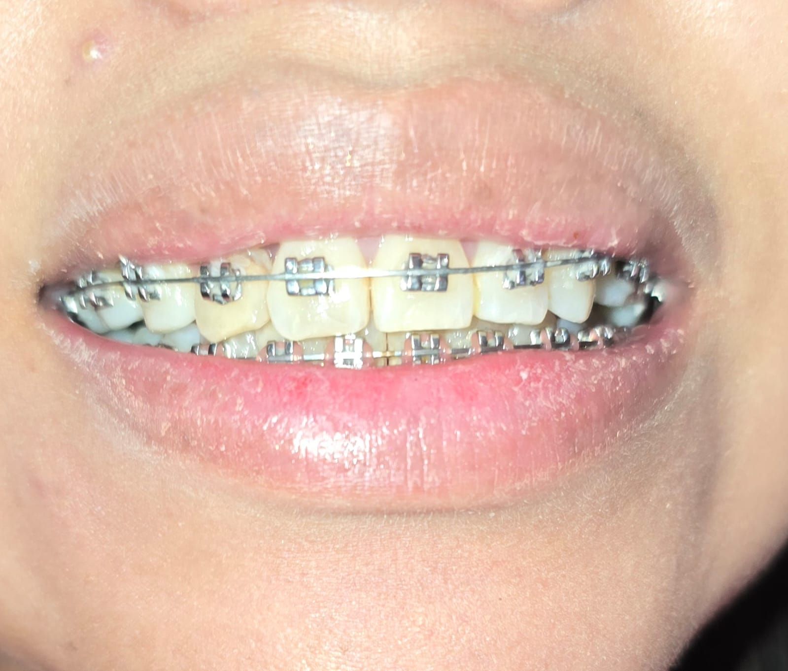 Primer plano de la boca de una persona con dientes cubiertos por aparatos plateados y los labios ligeramente separados.