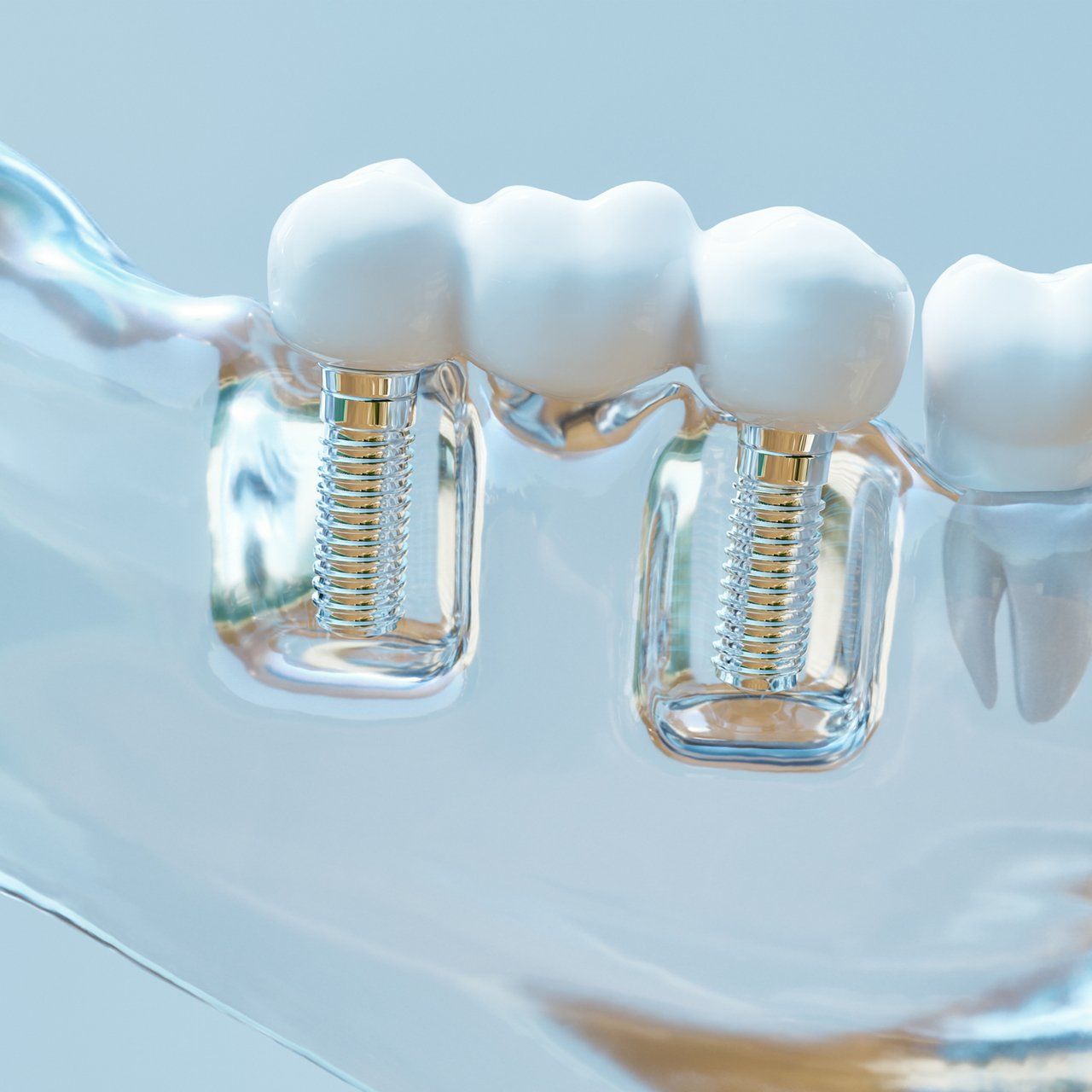 Intra-Lock Dental Implant — Frankfort, IL — Brookside Dental Care