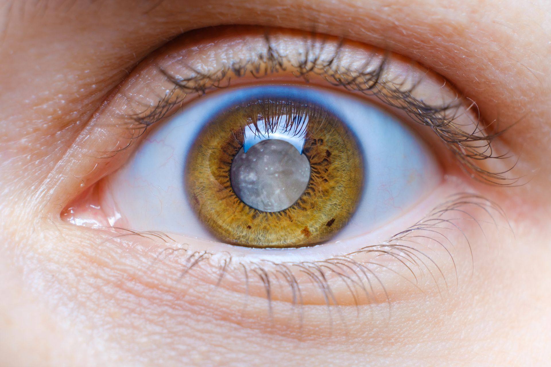 Eye Cataract - Midland, TX - The Eye Institute