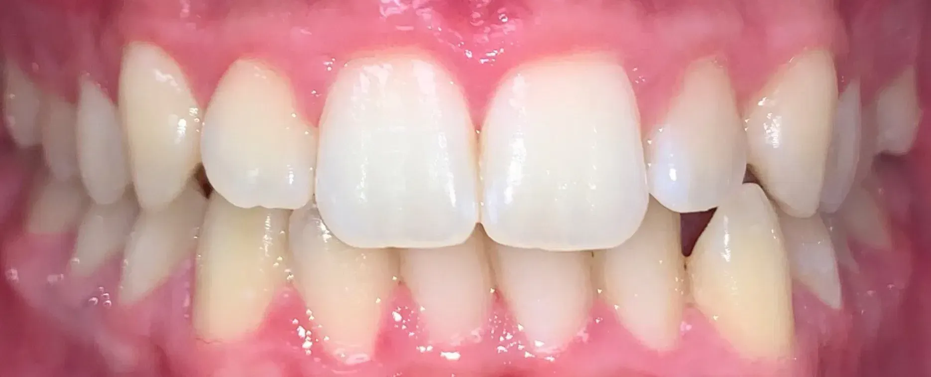 A close up of a man 's teeth with a beard.