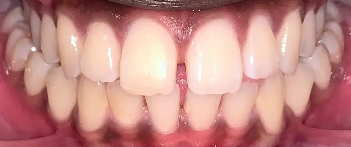 A close up of a man 's teeth with a beard.