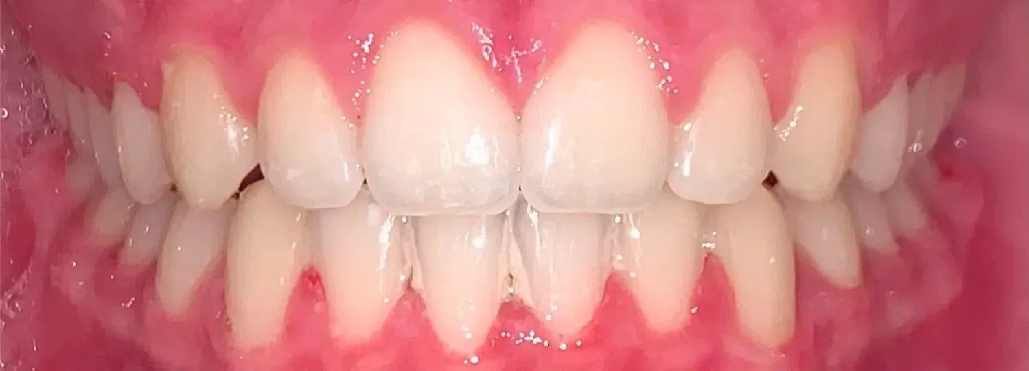 A close up of a man 's teeth with a beard.