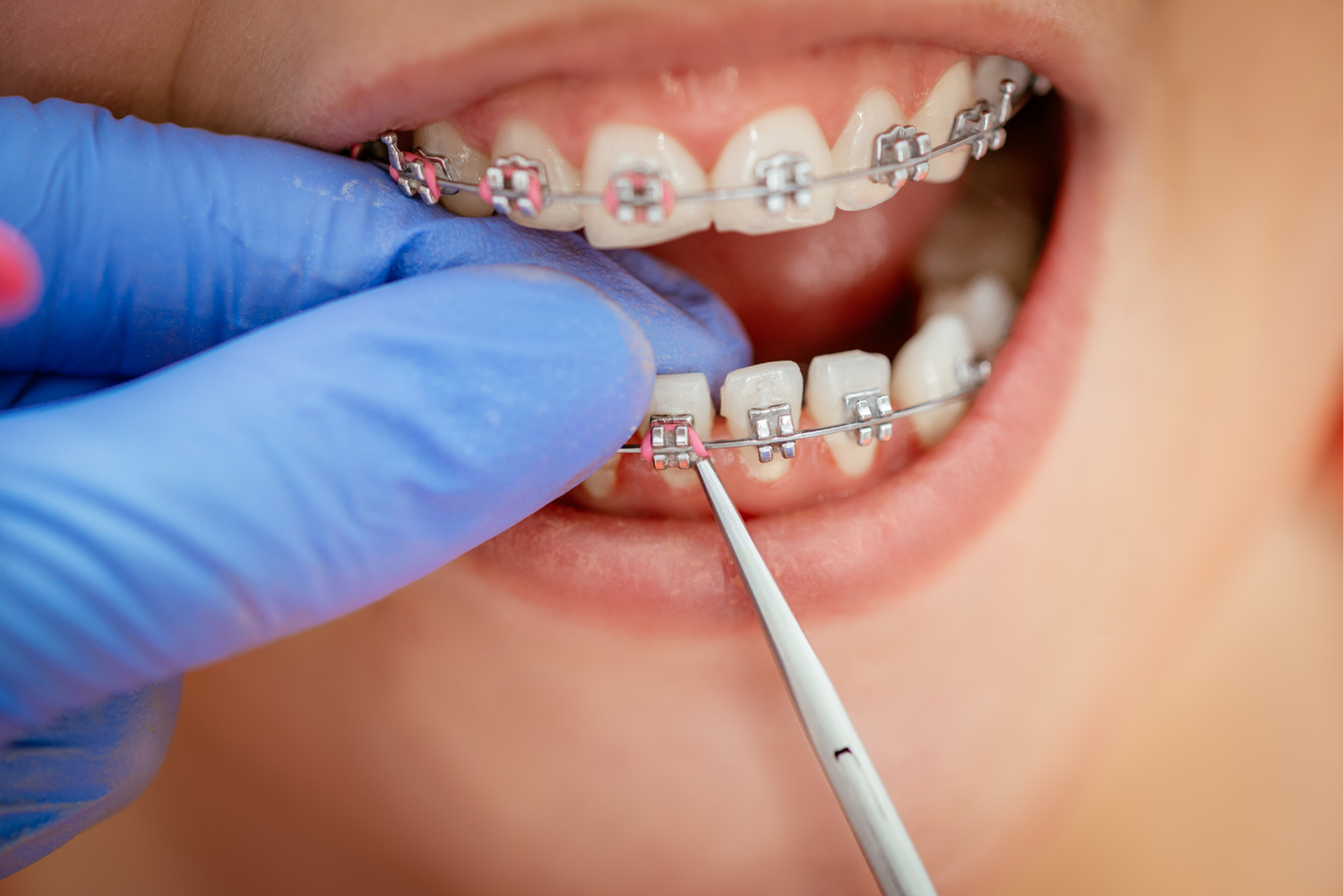 Close-up of a person's mouth with braces; gloved hand using a dental tool to adjust the wire.