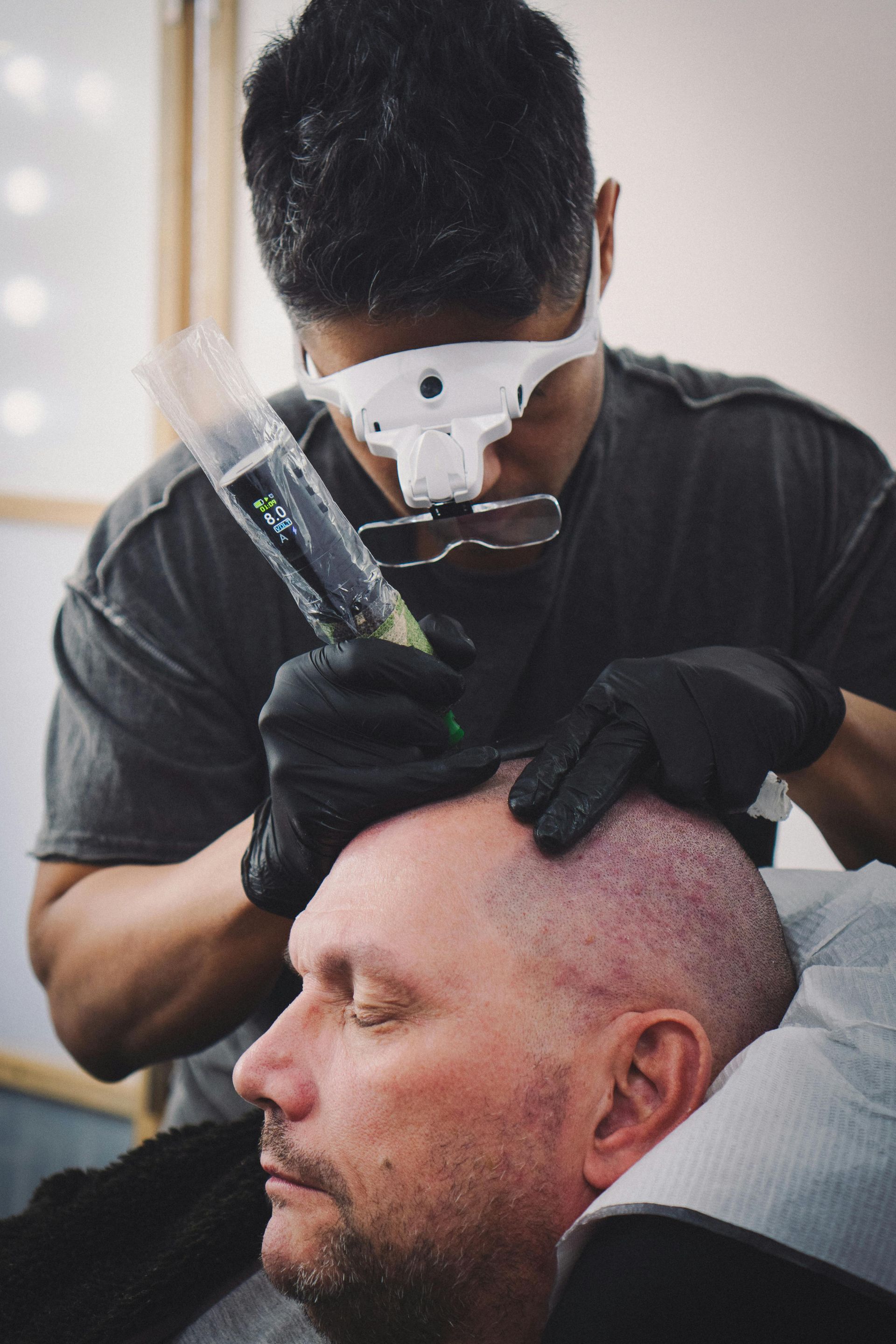 An SMP practitioner is tattooing scalp pigmentation on a client as part of his training course