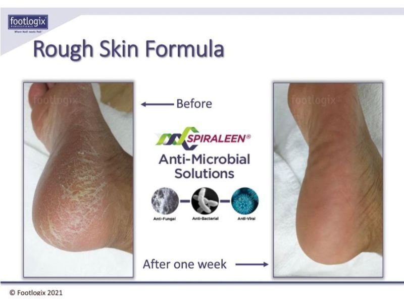 before and after view of rough skin formula treatment