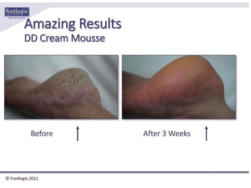 before and after results view of dd cream mousse