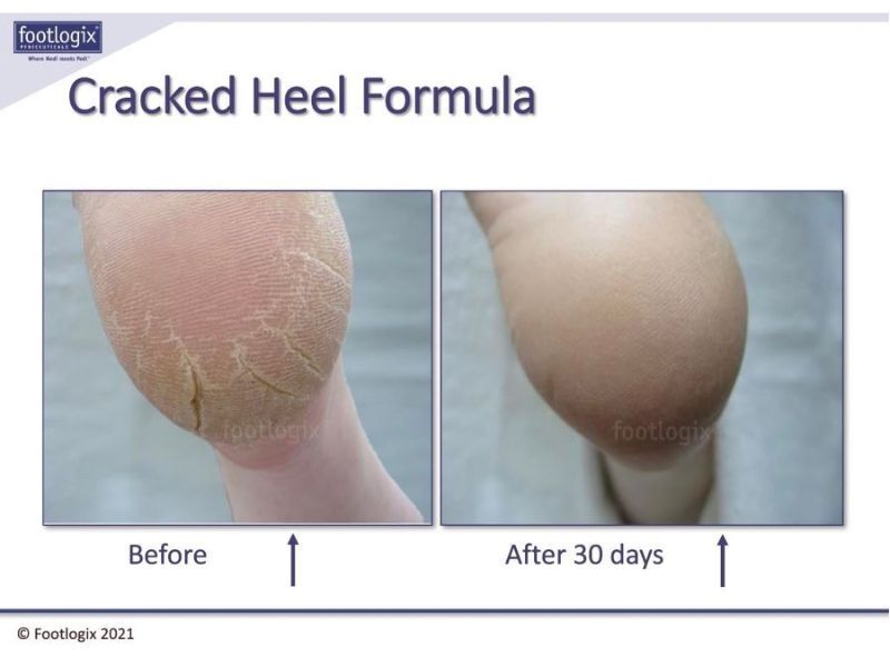 before and after cracked heels formula