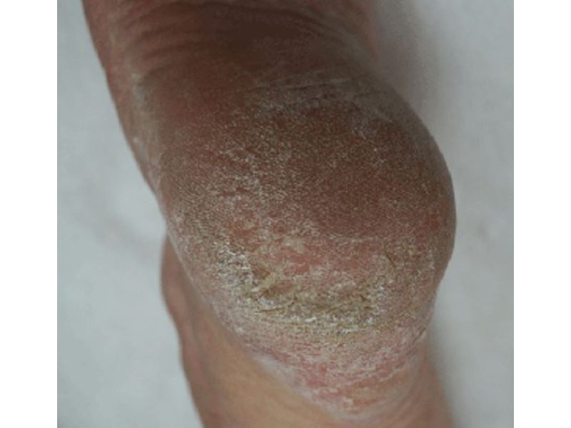 back view of cracked heels