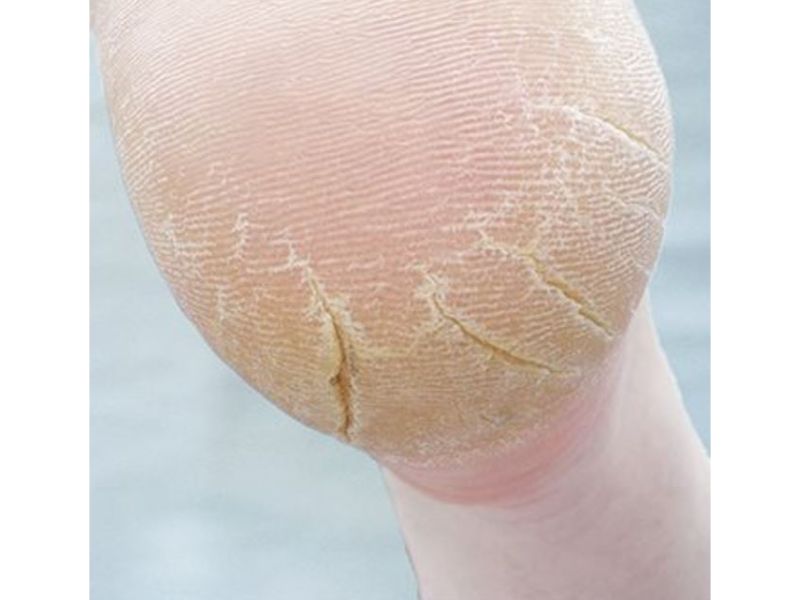 close view of cracked heels