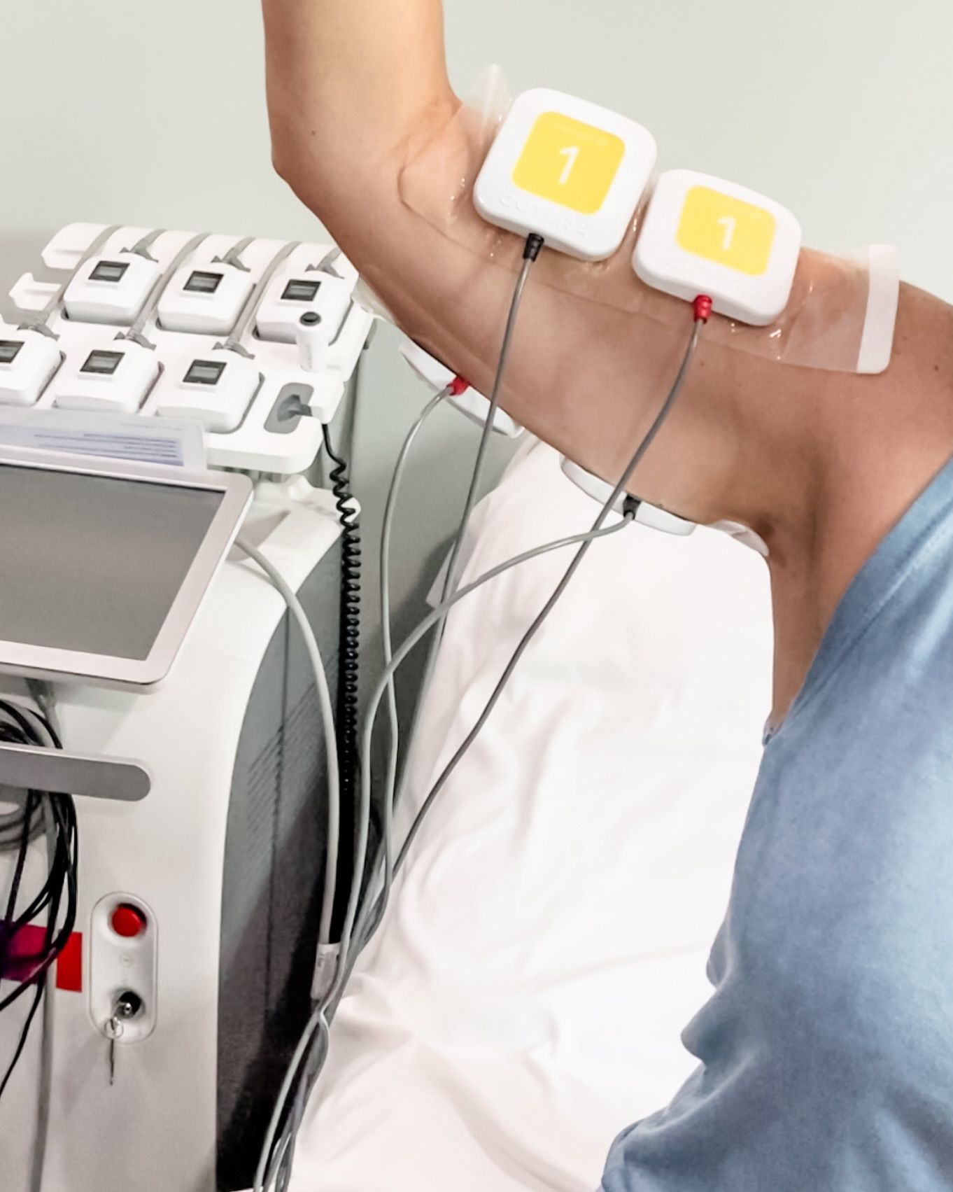 A Person Is Getting Electrodes on Their Arm — LaGrange, GA — LaGrange Body Lab