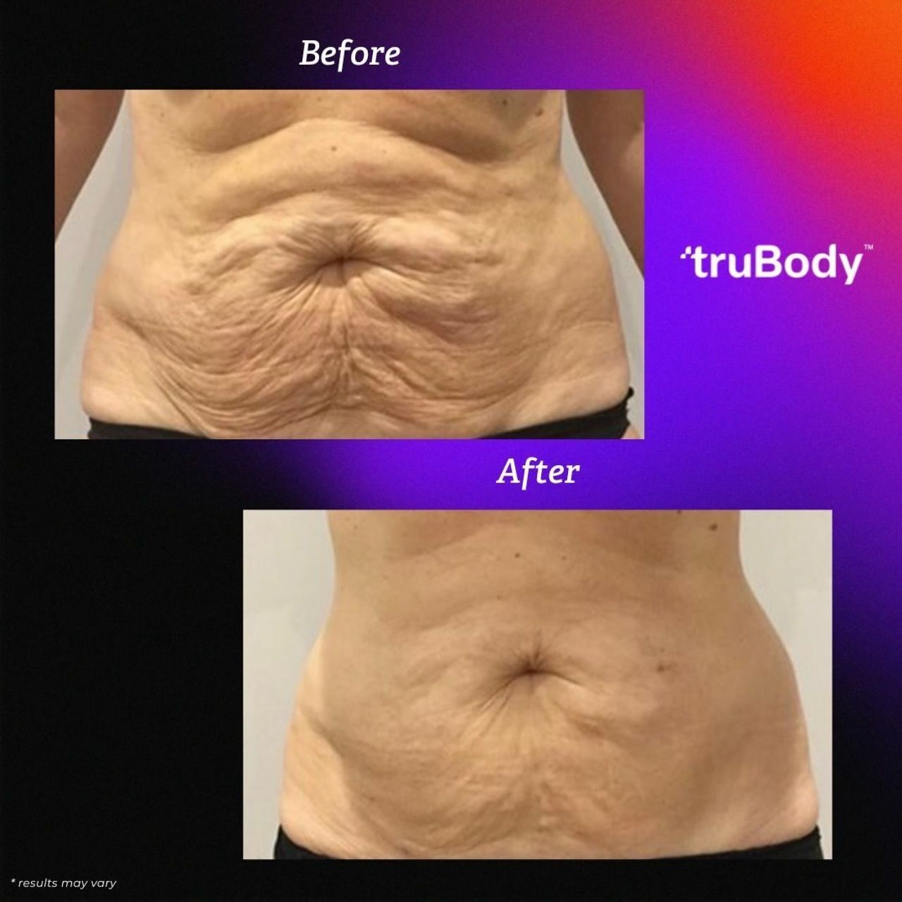 Before and After TruBody Result — LaGrange, GA — LaGrange Body Lab