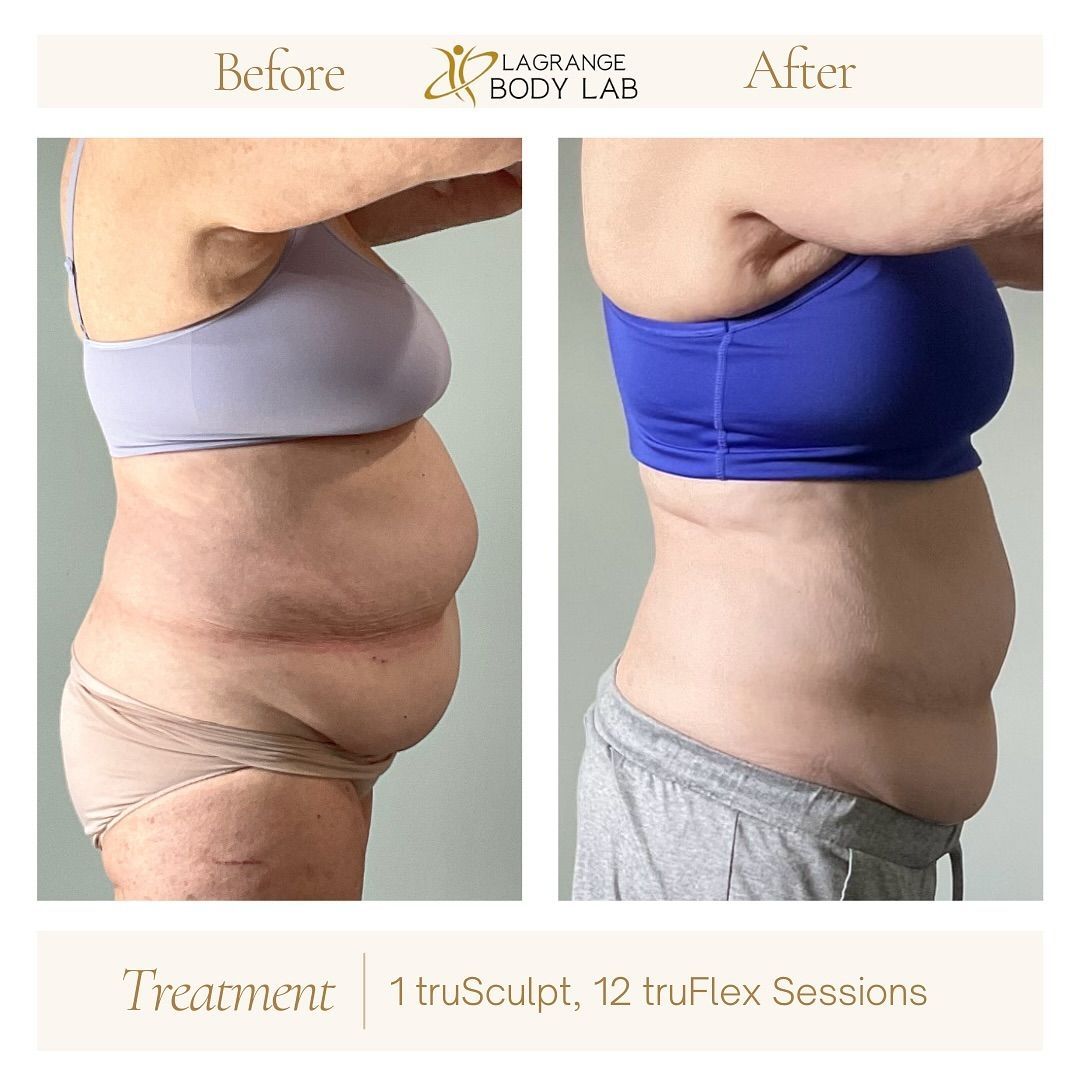 A Before and After Treatment Result — LaGrange, GA — LaGrange Body Lab