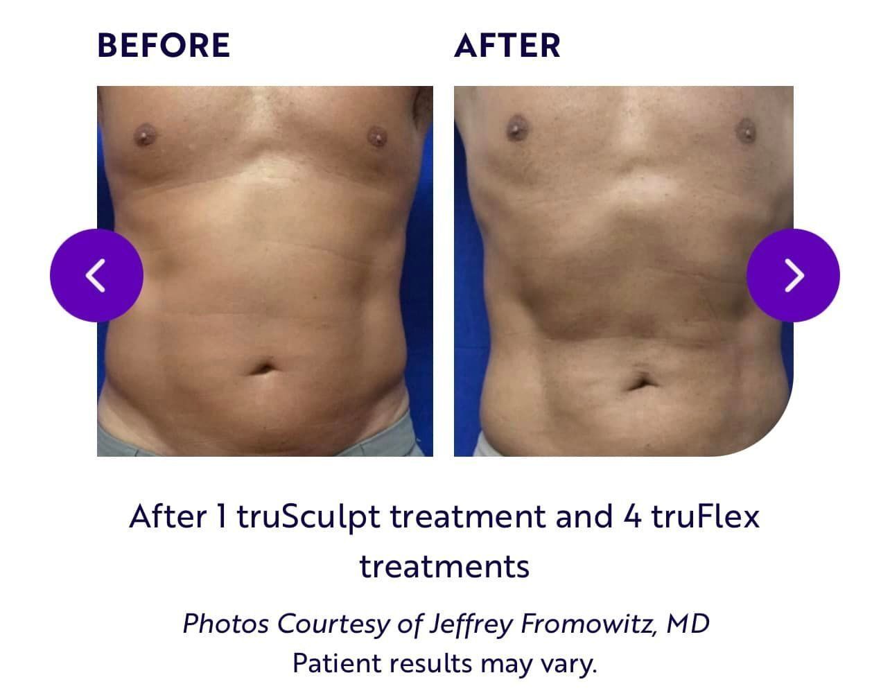 A Before and After Picture of A Man's Torso — LaGrange, GA — LaGrange Body Lab