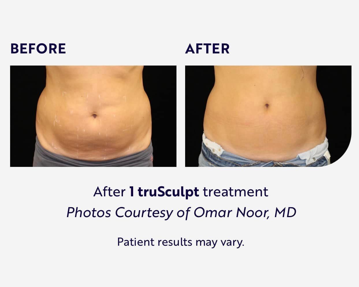 A Before and After Photo of A Woman's Stomach — LaGrange, GA — LaGrange Body Lab