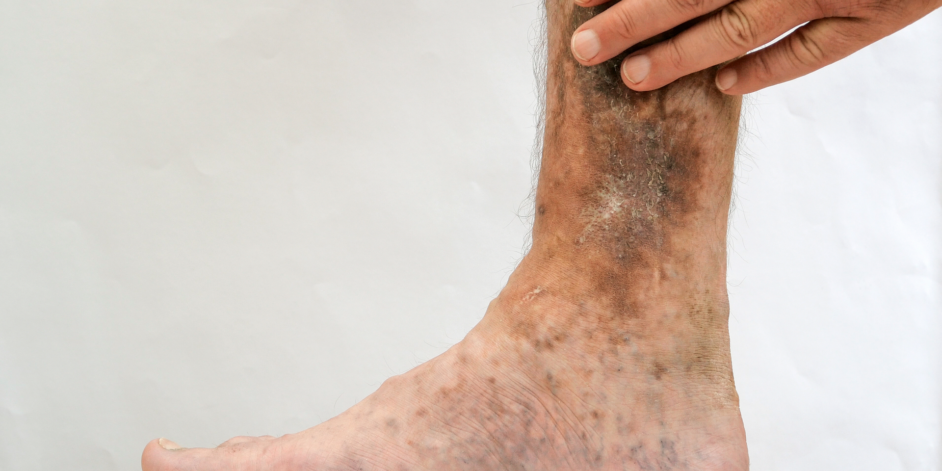 A close up of a person 's leg with varicose veins.
