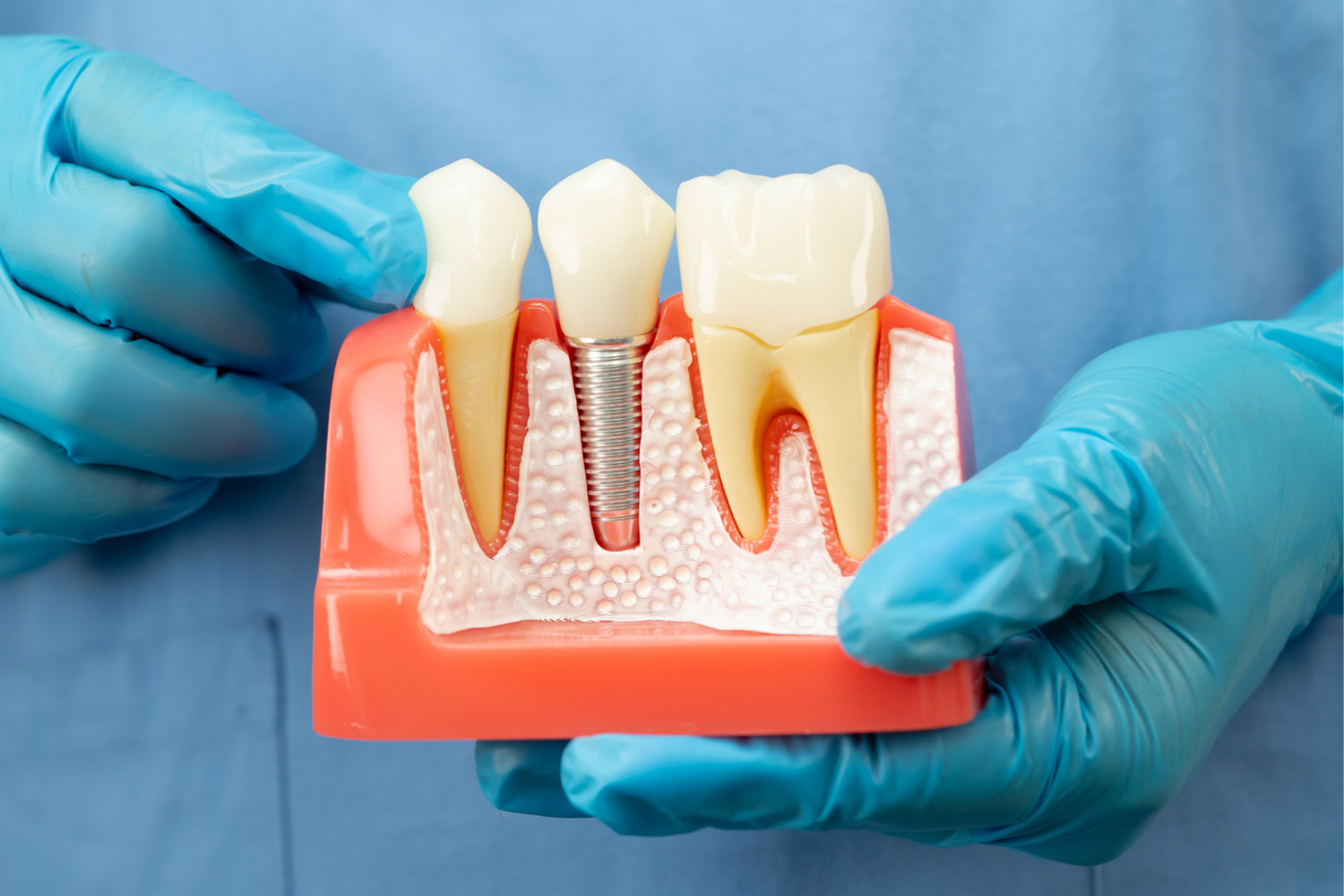 Hands in blue gloves holding a dental model showing a tooth implant, healthy tooth, and model tooth.