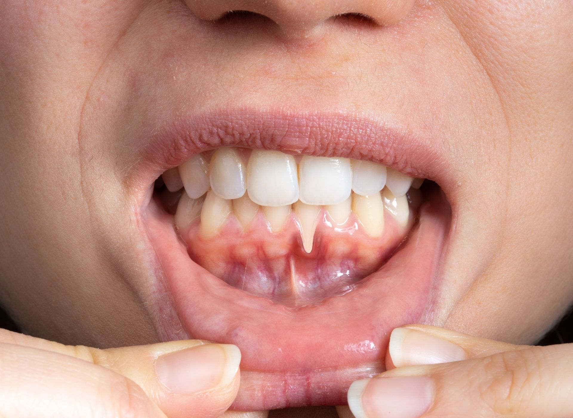 Close-up of a dental implant with a screw post in the jawbone, and healthy teeth alongside.