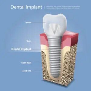 Dental Implant Graphic | Dental Implants in Richmond, MO 64085 and Lawson MO