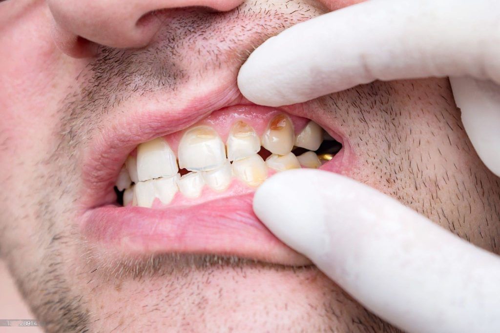 A man is getting his teeth examined by a dentist.