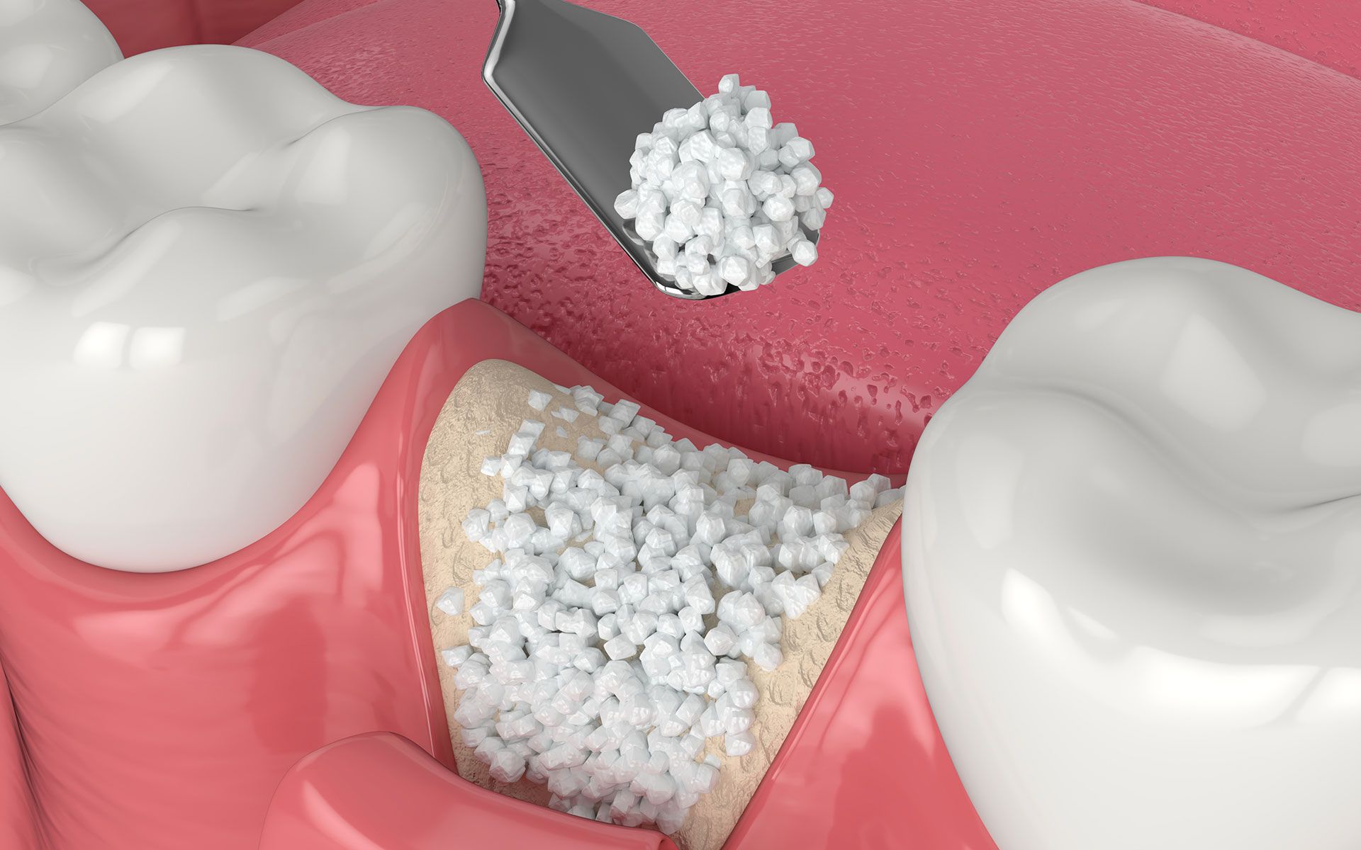 A close up of a tooth with a spoon in it.