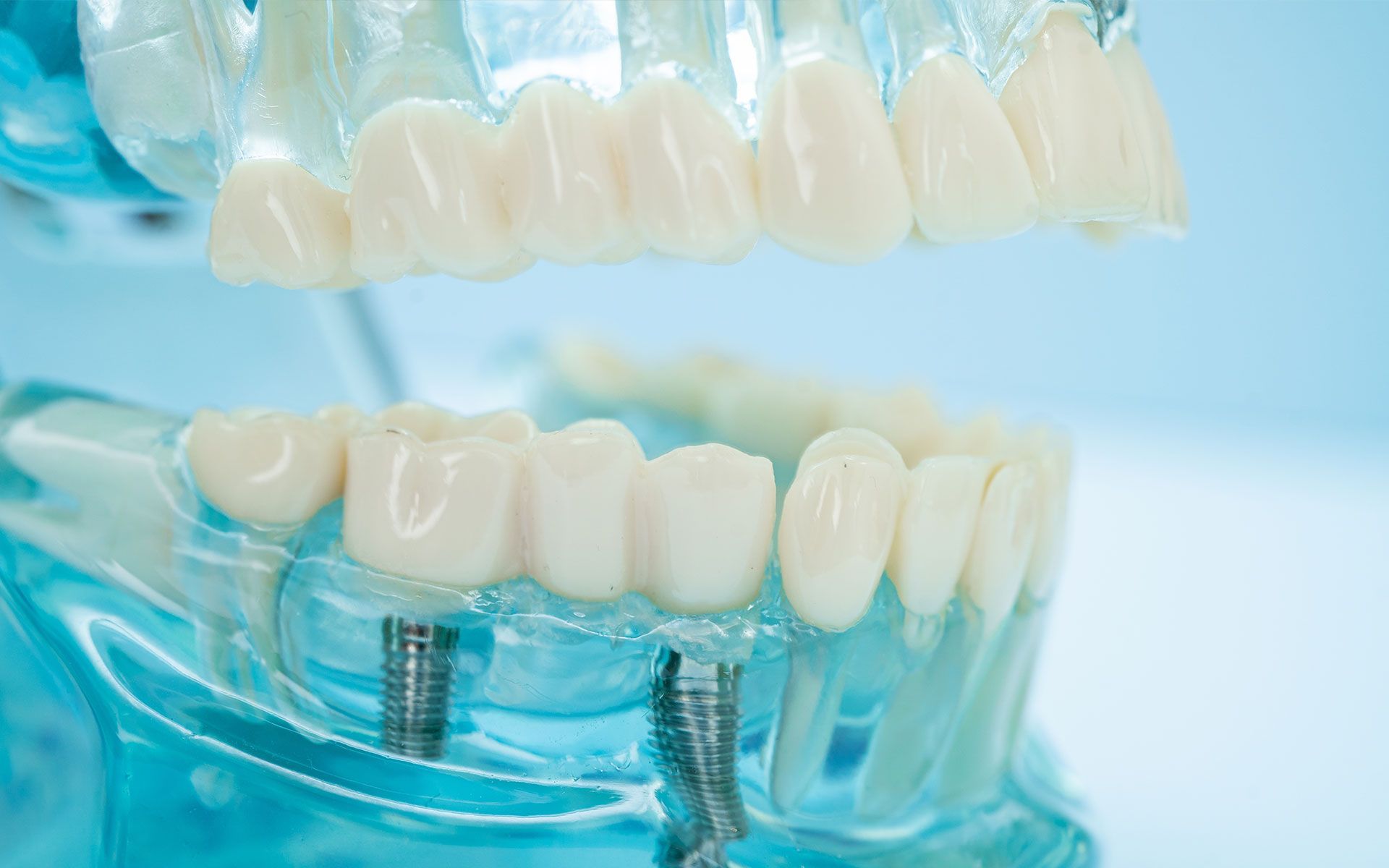 A close up of a model of a dental bridge with dental implants.