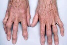 DR. JUAN FCO. LÓPEZ GARZA - ARTRITIS