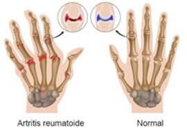 DR. JUAN FCO. LÓPEZ GARZA - ARTRITIS REUMATOIDE