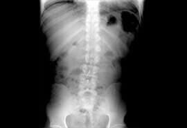 DR. JUAN FCO. LÓPEZ GARZA - OSTEOARTROSIS