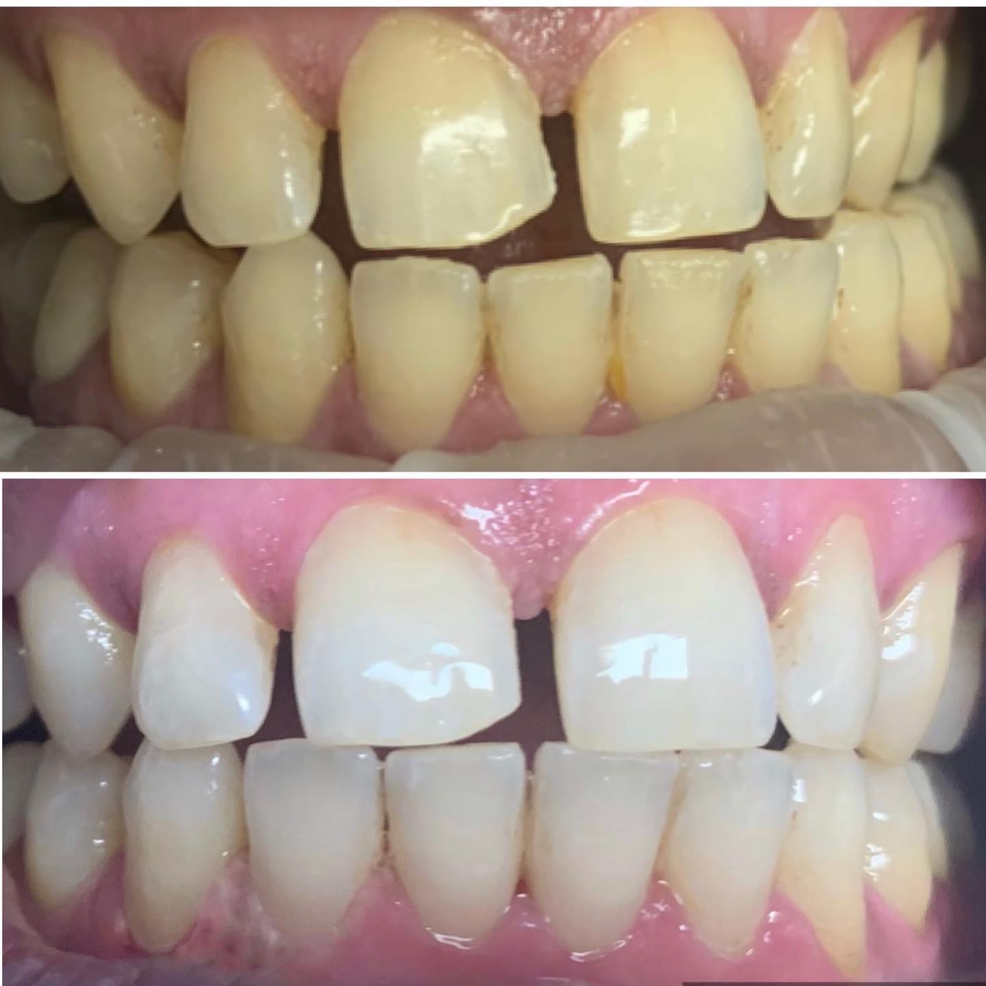 Before and after cleaning of the teeth – Blacktown, NSW – Smiles for All