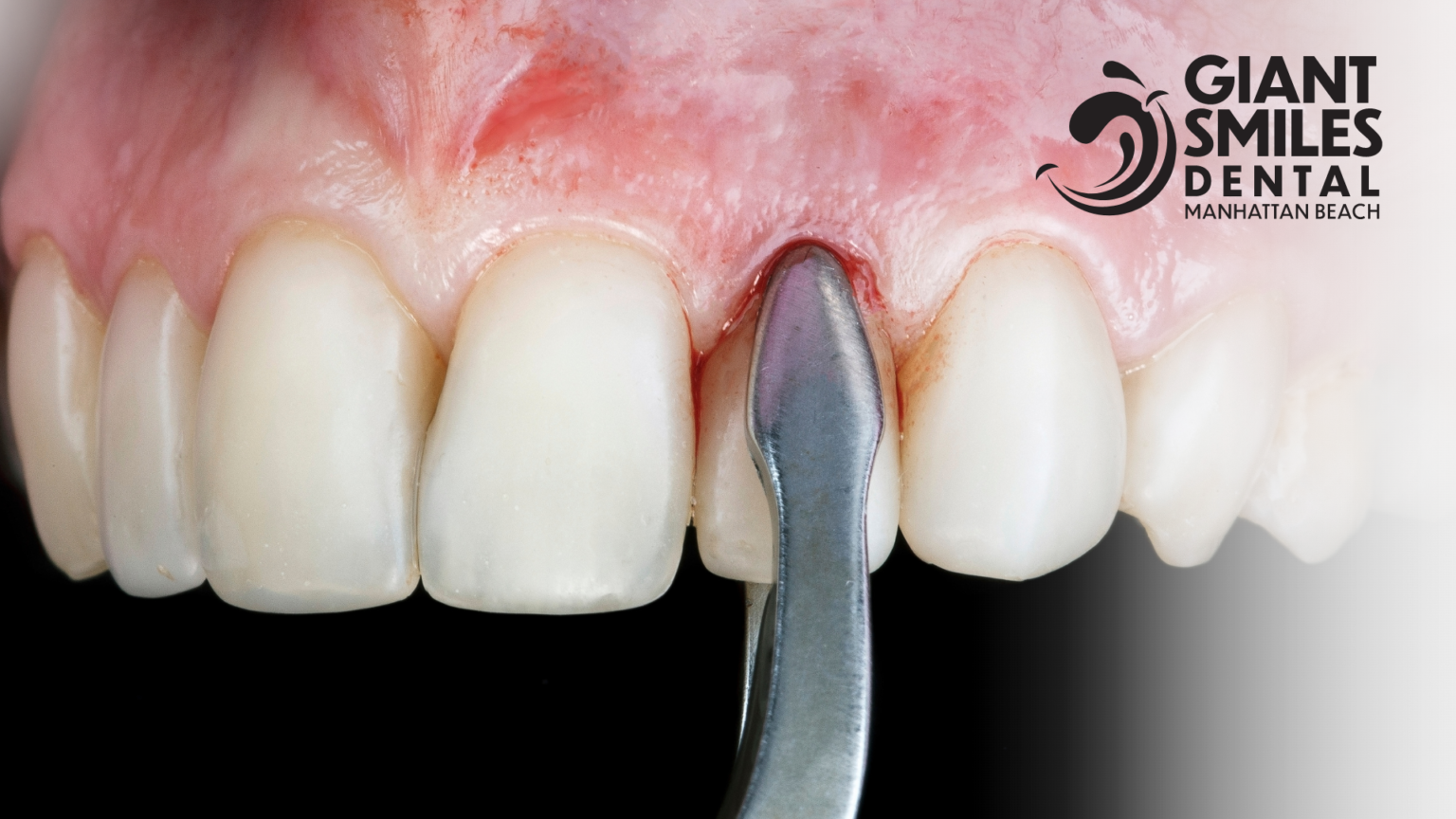 A close up of a person 's teeth with a giant smiles dental logo in the background