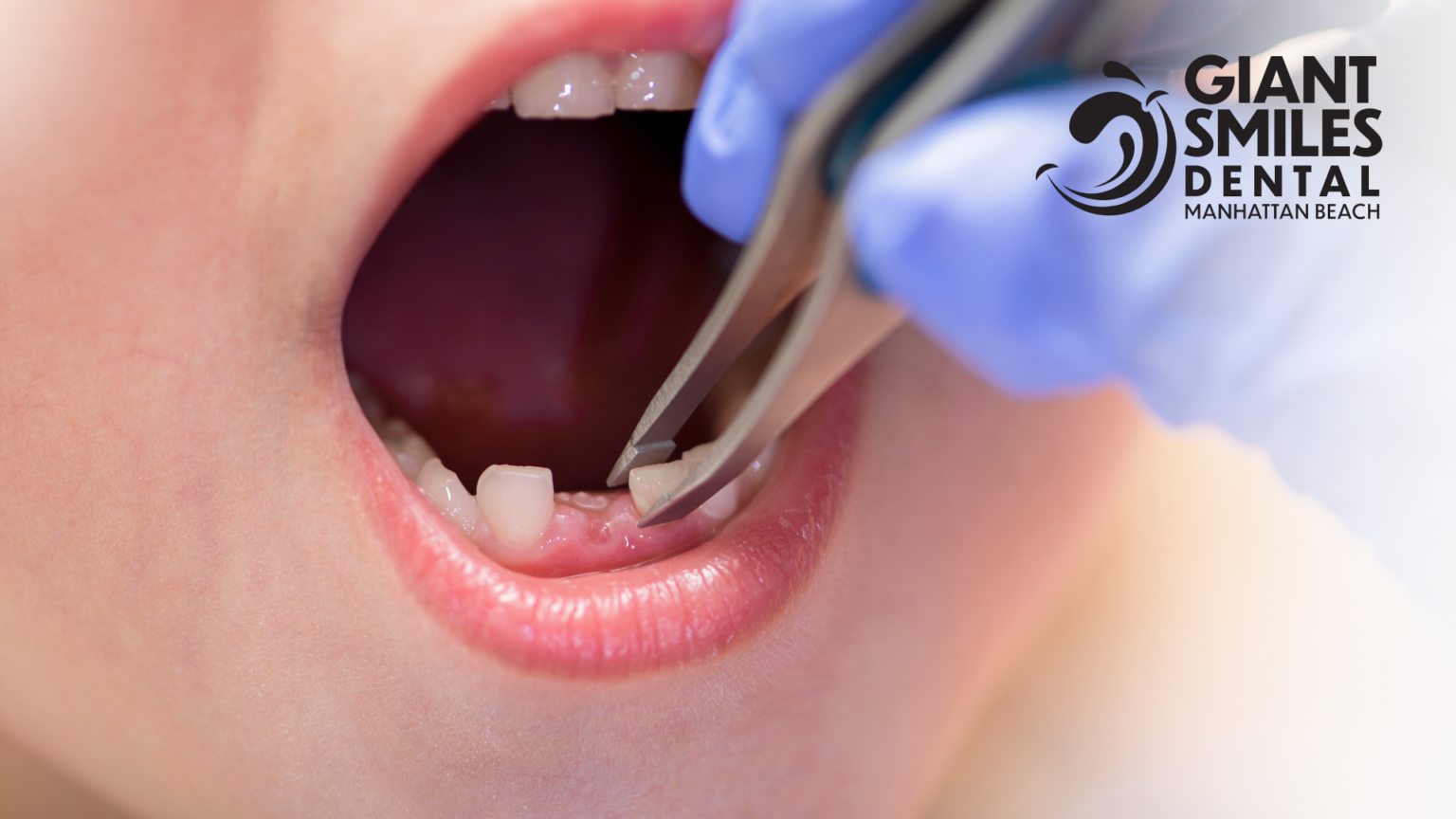 A child is getting their teeth removed by a dentist.