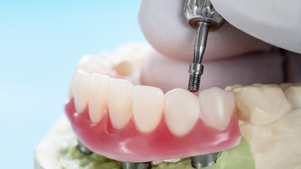 A person is using a drill to install a denture on a model of teeth.