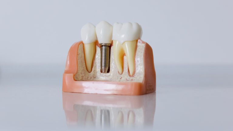 A model of a tooth with a dental implant in it.