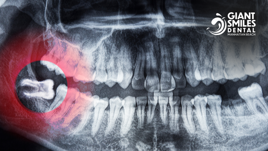 An x-ray of a person 's teeth showing a wisdom tooth.