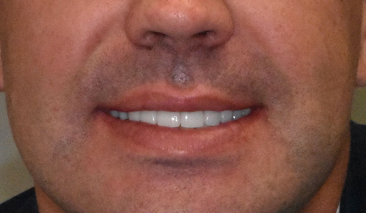 A close up of a man 's mouth with white teeth