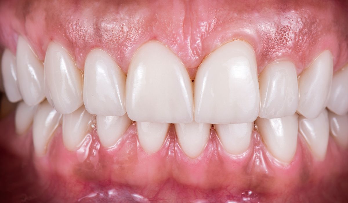 A close up of a person 's teeth with white teeth.