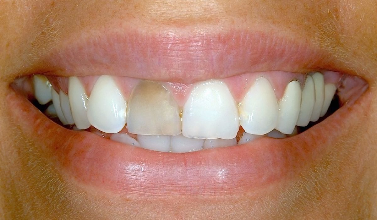 A close up of a woman 's smile with white teeth.