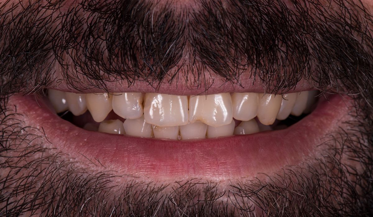 A close up of a man 's teeth with a beard.