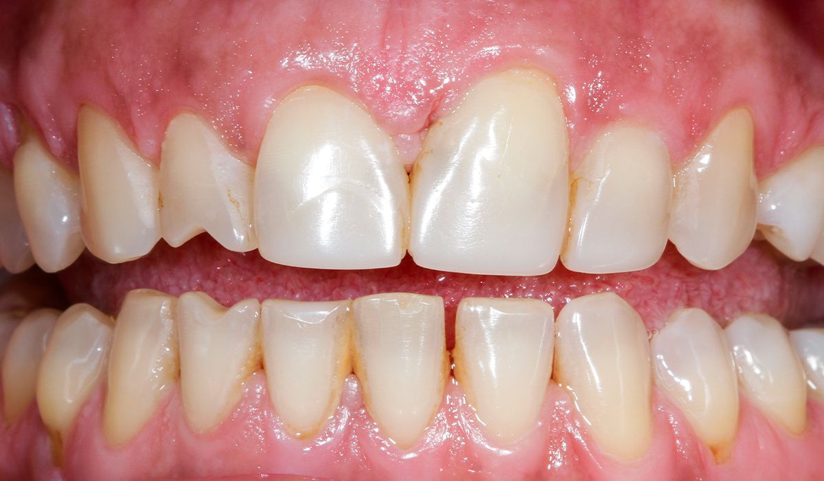 A close up of a person 's teeth with a missing tooth.