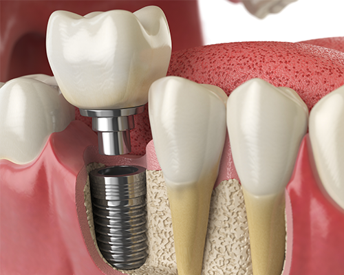 A close up of a tooth with a dental implant in it.