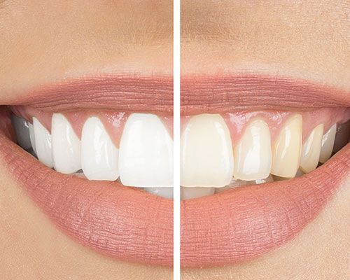 A before and after picture of a woman 's teeth.