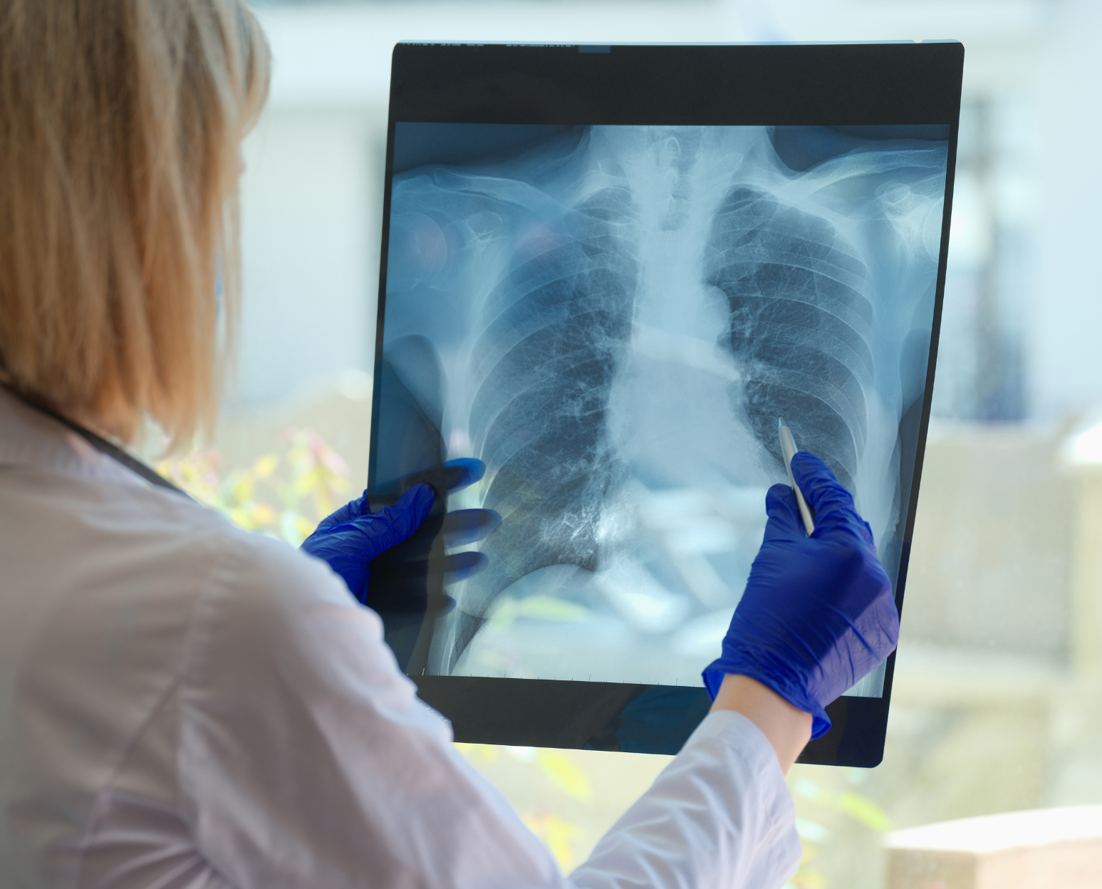 A doctor is looking at an x-ray of a person 's lungs.