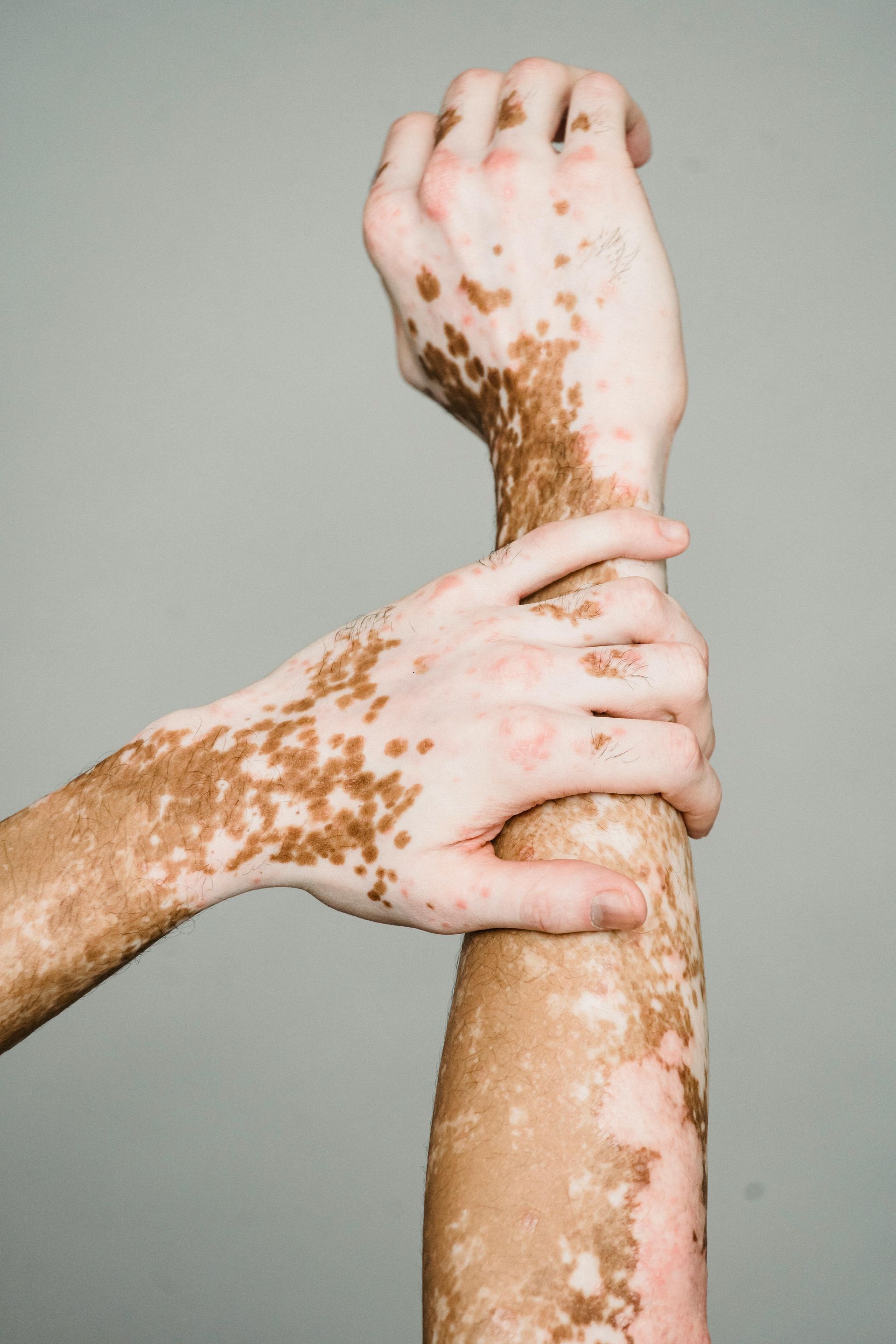 A person with vitiligo is holding another person 's arm.