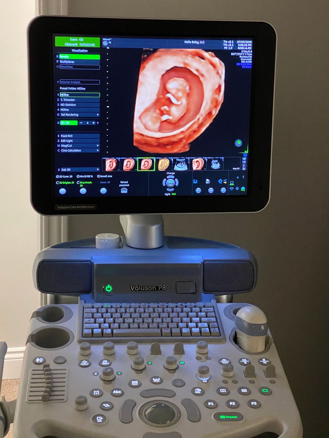 An ultrasound machine with a picture of a baby on the screen