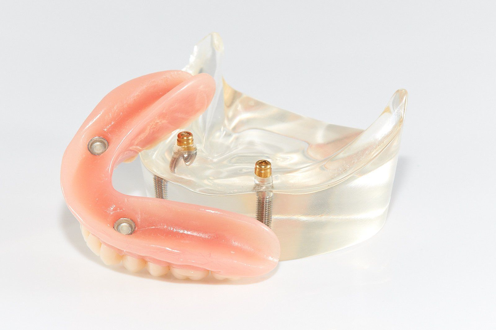 Implant Denture — Bromley's Denture Clinic in Tweed Heads South, NSW