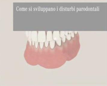 La malattia parodontale